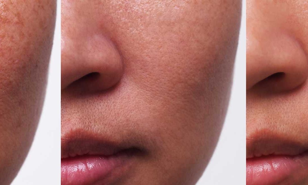 Can Sunspots Be Removed by Laser Therapy?