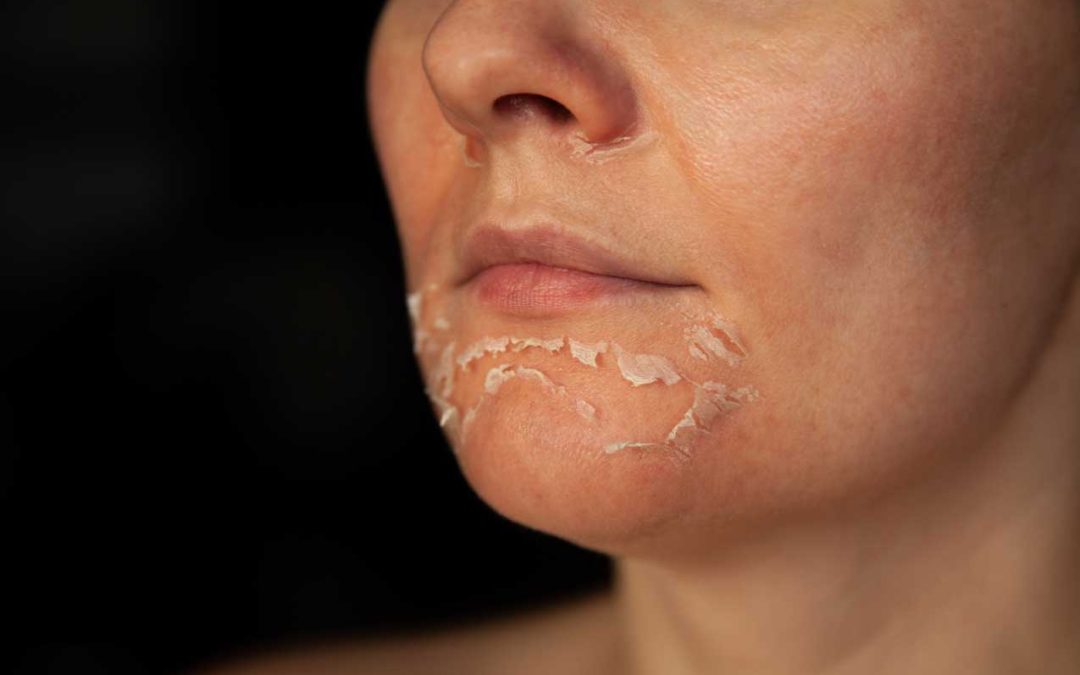 What is a Vi Peel, and How Does it Work?