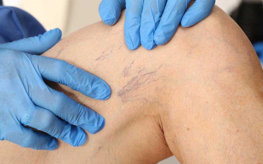What Are Spider Veins and Can They Be Removed?
