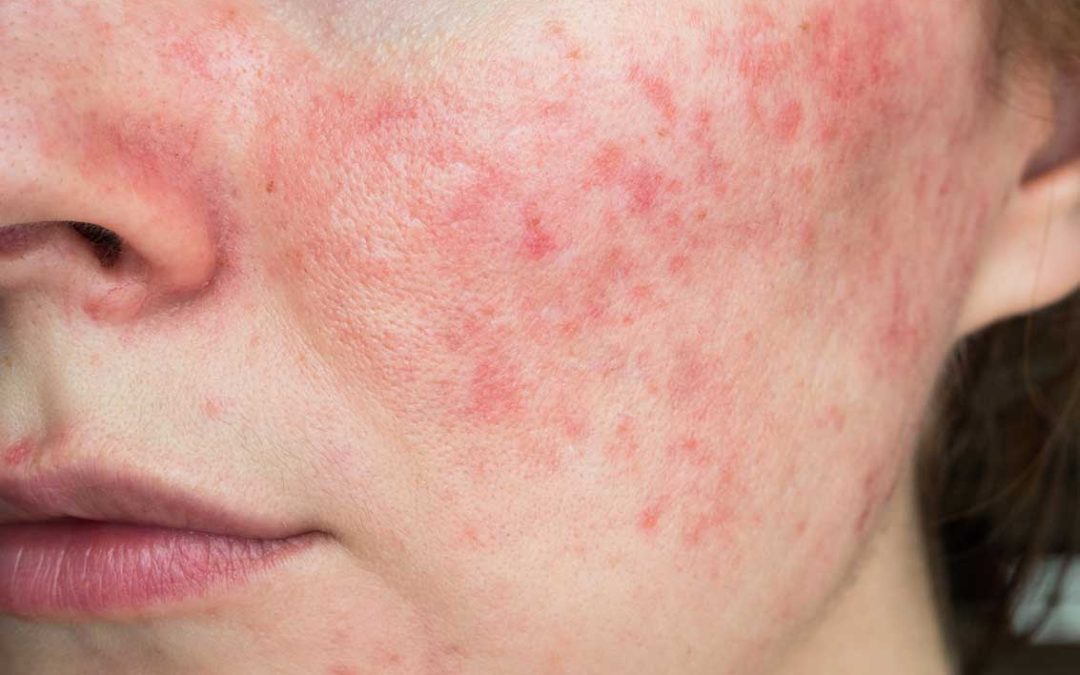 All About Rosacea: What Is It and How to Treat It