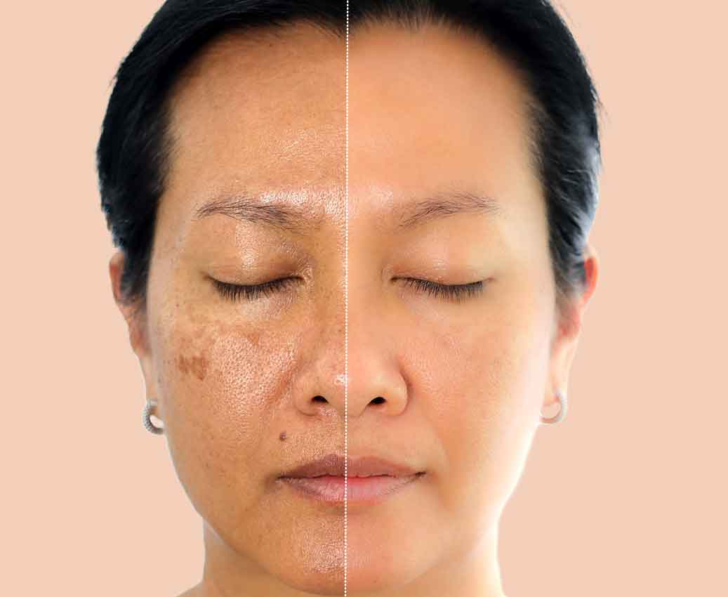 Brown-Spots-or-Capillaries-189-per-area