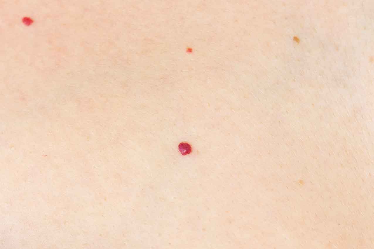 Cherry-Angiomas-179-Per-Area