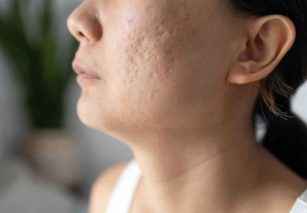 Acne Scars