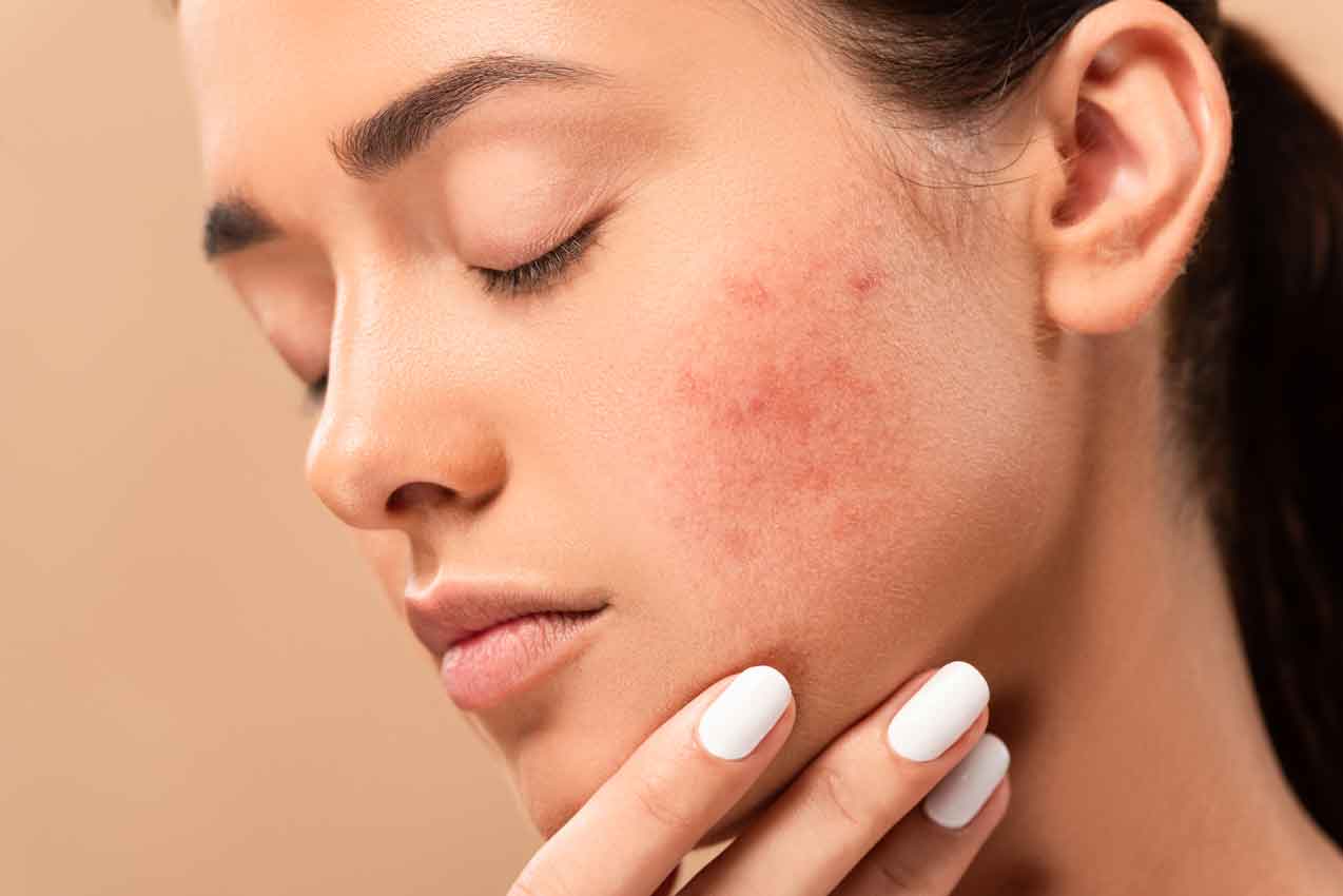 Make sure your skin is calm