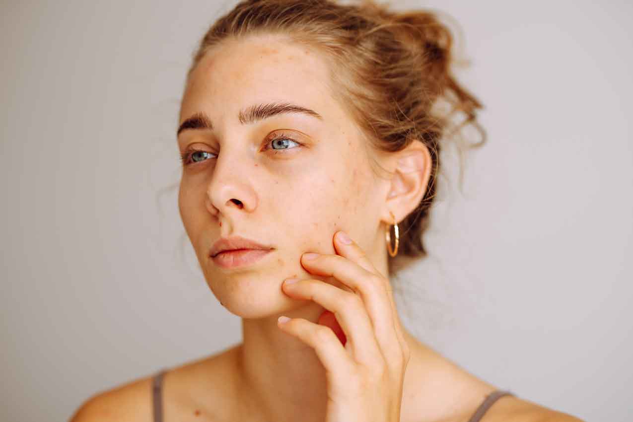 Rosacea or Sensitive Skin